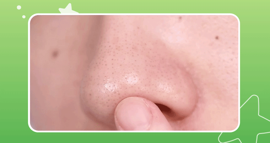 Ilso Natural Mild Clear Nose Pack 10 Sheets (Crayon Shin-chan Collab, +Grip Strap + 20 Cotton Swabs) detail 19